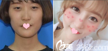 广州艺美李闯割双眼皮案例 广州艺美李闯割双眼皮案例