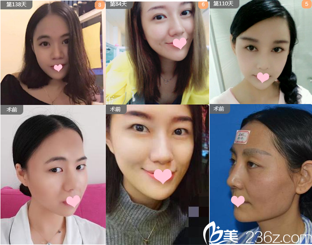 广州艺美整形医院张涛主任双眼皮案例