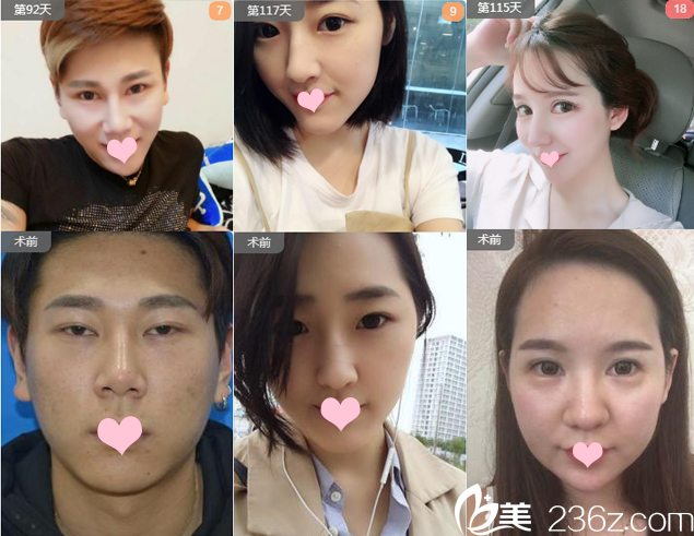 广州艺美整形医院张涛双眼皮修复案例