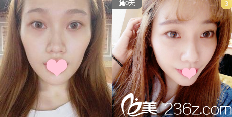 广州艺美整形医院张涛主任脂肪填充案例