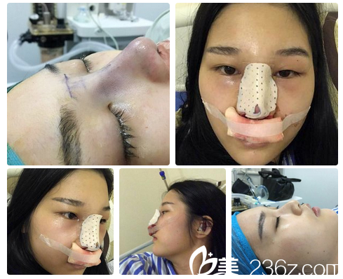 广州艺美李闯鼻修复即刻效果 广州艺美李闯鼻修复即刻效果