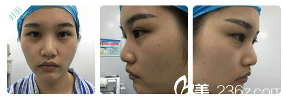 隆鼻失败术前照片 隆鼻失败术前照片