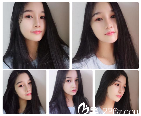 广州艺美李闯鼻修复3个月照片 广州艺美李闯鼻修复3个月照片