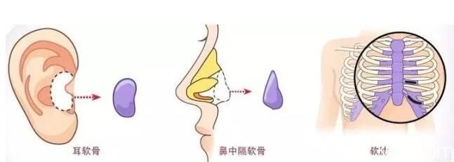 韩国VIP整形外科自体组织鼻整形 韩国VIP整形外科自体组织鼻整形