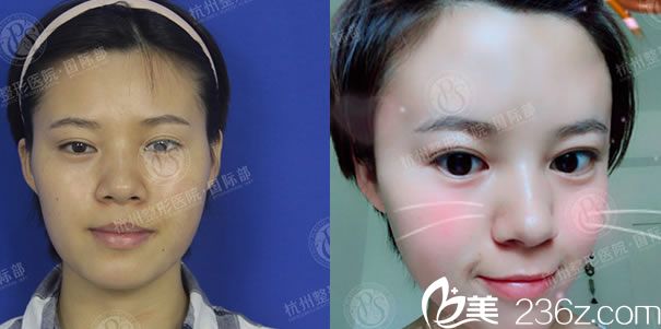 自体脂肪填充额头四个月效果对比图 自体脂肪填充额头四个月效果对比图