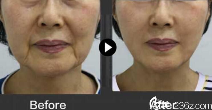 韩国德社罗伊整形外科朴明旭院长面部提升案例 韩国德社罗伊整形外科朴明旭院长面部提升案例