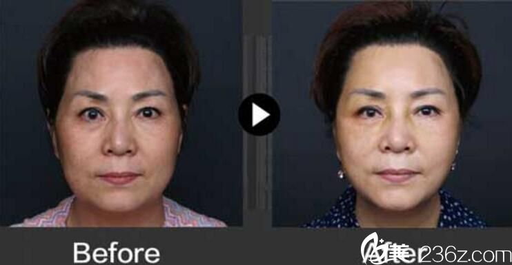 三重埋线提升 朴明旭院长 三重埋线提升 朴明旭院长