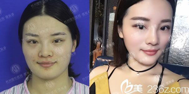 杭州爱琴海自体脂肪填充全脸案例 杭州爱琴海自体脂肪填充全脸案例