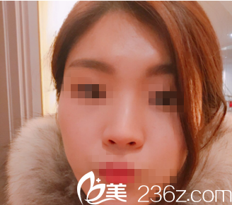 韩国心美眼整形外科医院案例 韩国心美眼整形外科医院案例