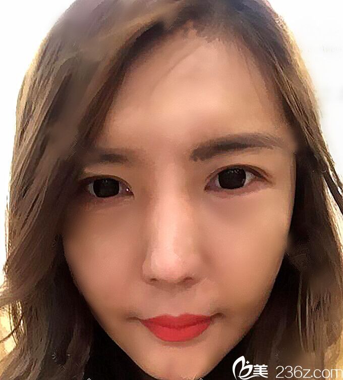 韩国德社罗伊整形外科朴明旭院长埋线提升真人案例 韩国德社罗伊整形外科朴明旭院长埋线提升真人案例