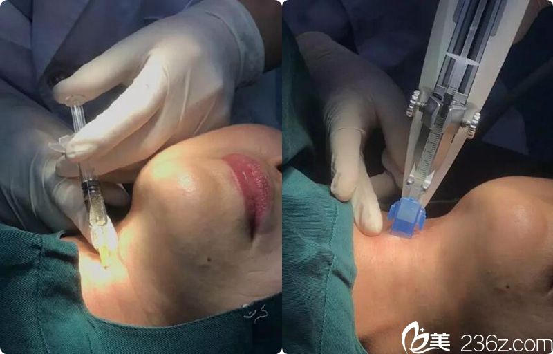 嗨体去颈纹过程