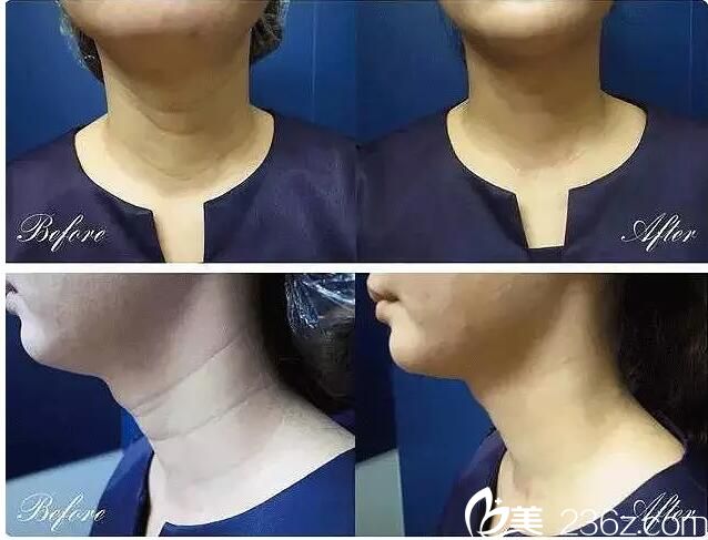 嗨体注射除皱术后即刻效果