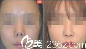  韩国VIP整形外科鼻子做的怎么样？朝天鼻矫正，鼻部修复案例对比图
