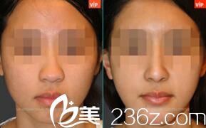  韩国VIP整形外科朝天鼻矫正