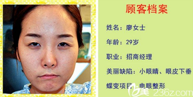 韩国新帝瑞娜整形医院双眼皮真人案例 韩国新帝瑞娜整形医院双眼皮真人案例