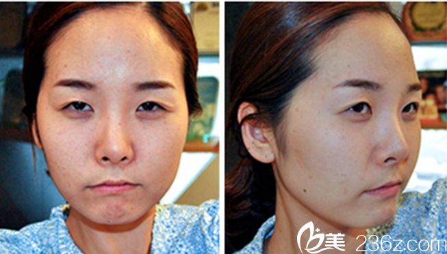 韩国灰姑娘整形郑钟必做双眼皮案例 韩国灰姑娘整形郑钟必做双眼皮案例