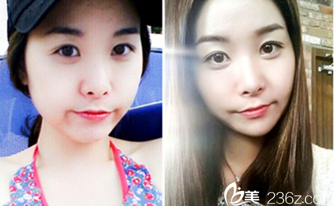 郑钟必院长做双眼皮手术好吗 郑钟必院长做双眼皮手术好吗