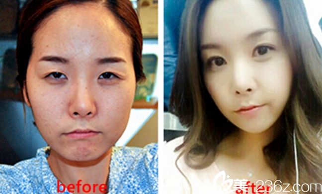 (灰姑娘整形)郑钟必院长做双眼皮大概多少钱?真人案例对比 (灰姑娘整形)郑钟必院长做双眼皮大概多少钱?真人案例对比