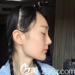 杭州整形医院唐冬生术前照片1