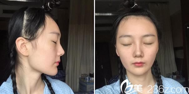 在<!--<i data=20240703-sp></i>-->做下颌角前 在<!--<i data=20240703-sp></i>-->做下颌角前