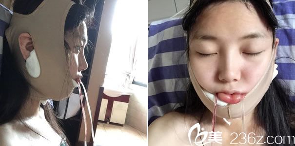 下颌角整形手术后戴头套照片 下颌角整形手术后戴头套照片