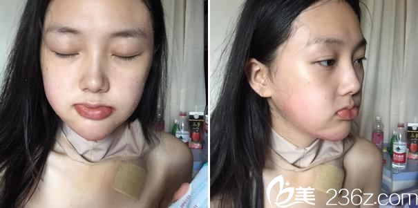 下颌角手术第3天拔引流管照片 下颌角手术第3天拔引流管照片