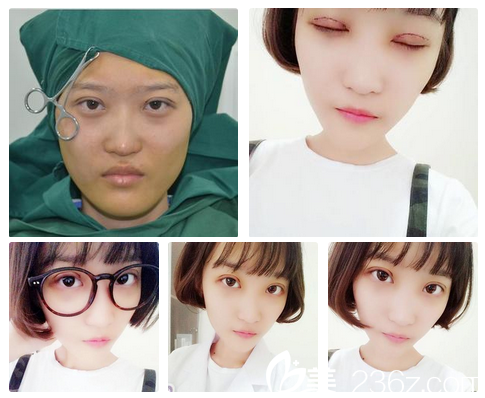 张涛主任双眼皮术后第二天