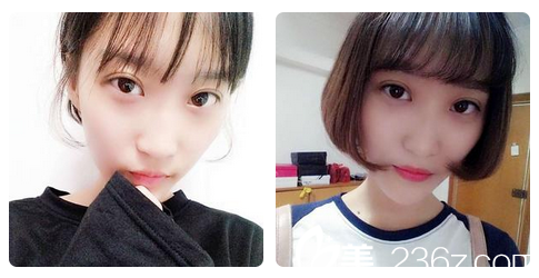 广州艺美张涛全切双眼皮8天