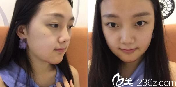 下颌角手术第4天照片 下颌角手术第4天照片