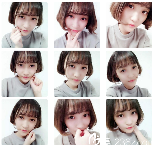 做全切双眼皮1个月恢复期照片