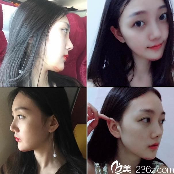 做下颌角手术第10天的效果 做下颌角手术第10天的效果