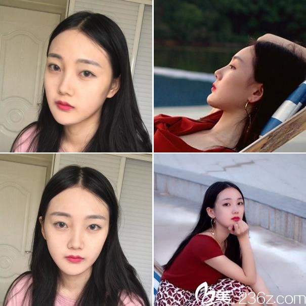 下颌角改脸型手术15天恢复图 下颌角改脸型手术15天恢复图