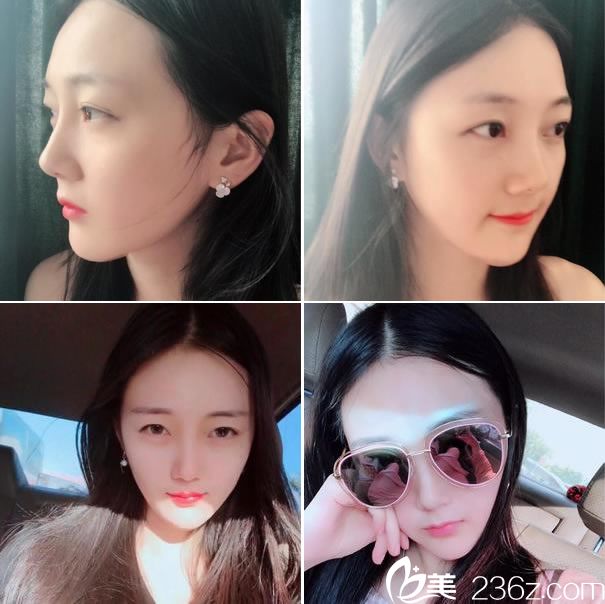 <!--<i data=20240703-sp></i>-->做下颌角22天效果 <!--<i data=20240703-sp></i>-->做下颌角22天效果