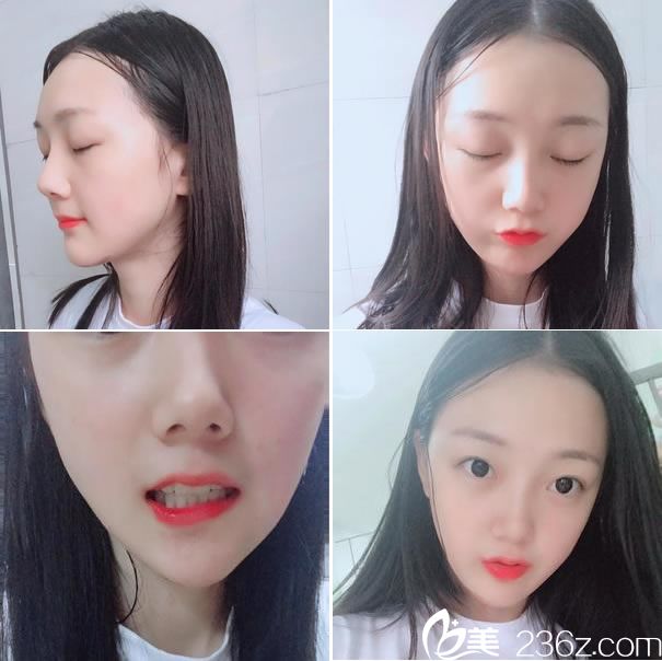 下颌角手术第35天恢复效果 下颌角手术第35天恢复效果