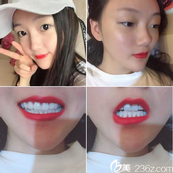 小V脸手术第55天恢复图片 小V脸手术第55天恢复图片