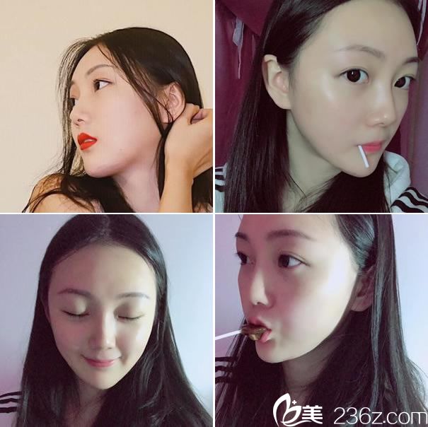 杭州整形唐冬生做下颌角效果 杭州整形唐冬生做下颌角效果