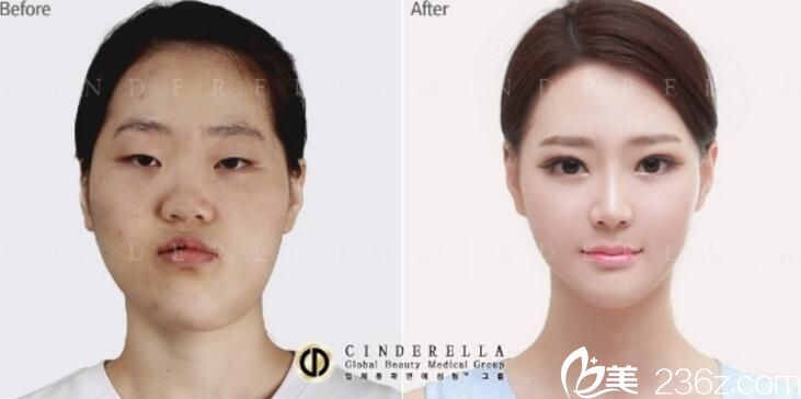 洪淳旻轮廓手术案例