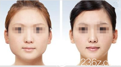 韩国艺德雅整形外科案例