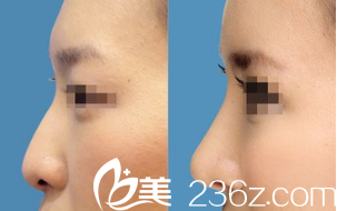 韩国艺德雅整形外科案例