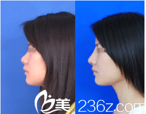 韩国艺德雅整形外科案例