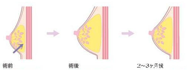 韩国艺德雅整形外科丰胸示意图 韩国艺德雅整形外科丰胸示意图