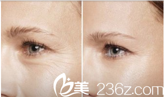 韩国艺德雅整形外科案例