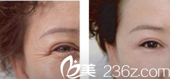 韩国艺德雅整形外科案例