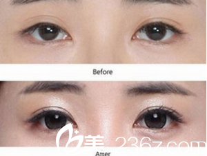 韩国艺德雅整形外科案例 韩国艺德雅整形外科案例