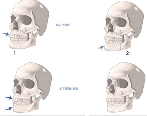 韩国艺德雅整形外科两颚矫正示意图