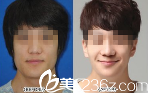 韩国艺德雅整形外科案例 韩国艺德雅整形外科案例