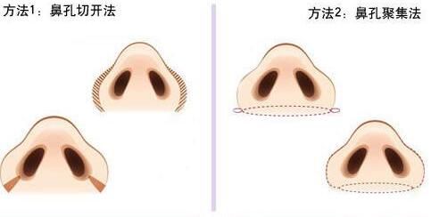 韩国VIEW必妩整形医院鼻翼缩小 韩国VIEW必妩整形医院鼻翼缩小