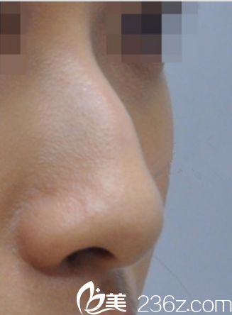 韩国艺德雅整形外科案例 韩国艺德雅整形外科案例