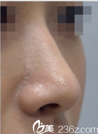在韩国艺德雅整形外科花26800元做驼峰鼻矫正，权章德院长案例
