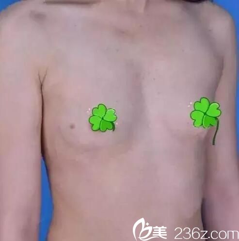 兰州时光整形美容医院贾治兰术前照片1